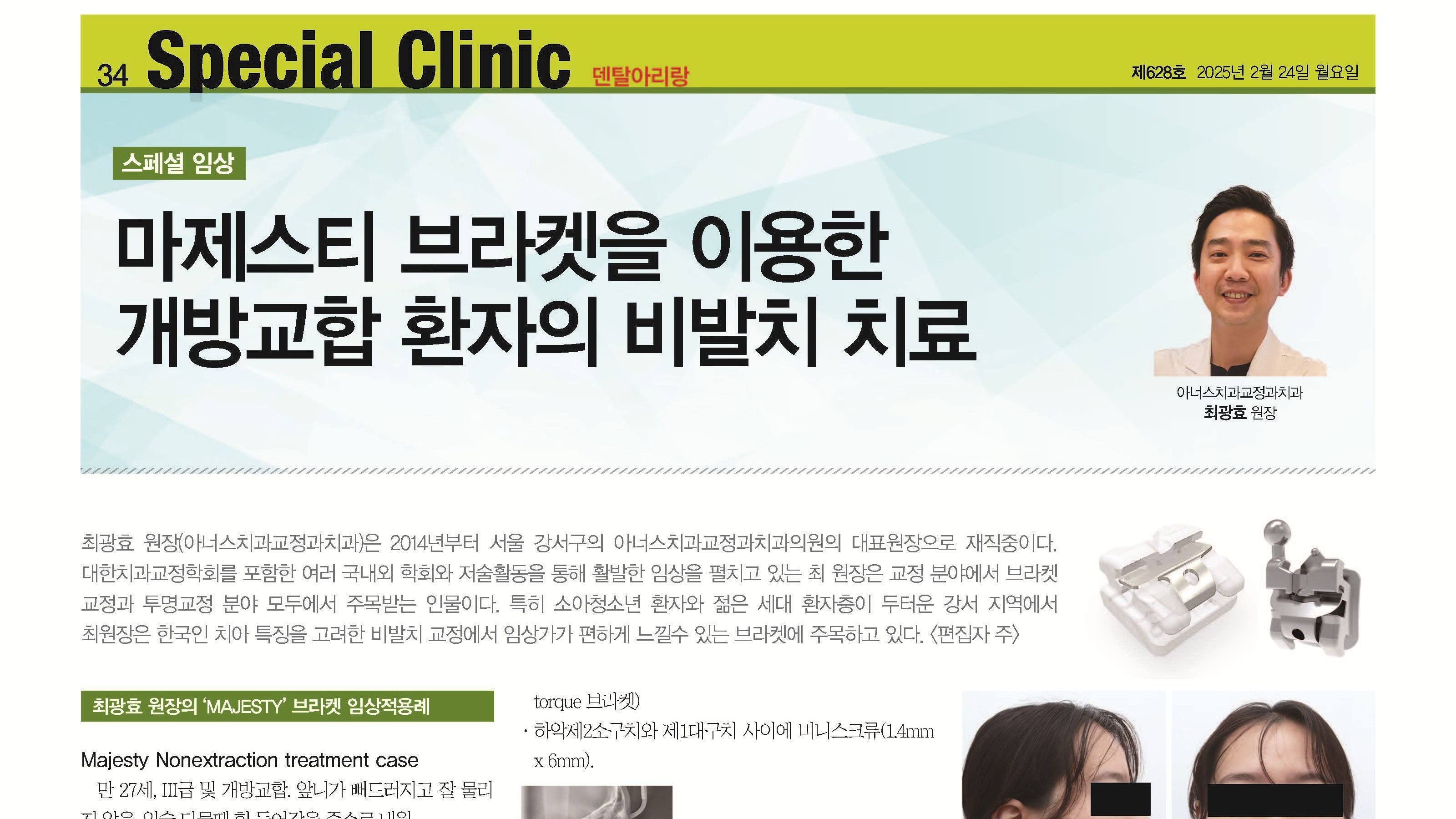 마제스티 임상케이스 2. 개방교합의 비발치 치료